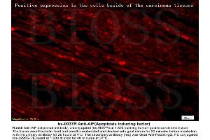 Formalin-fixed and paraffin embedded labeled with human gastric carcinoma Rabbit Anti-AIF Polyclonal Antibody, Unconjugated (ABIN724010) 1:300 followed by conjugation to the secondary antibody Goat Anti-Rabbit IgG, PE (AIF antibody  (AA 131-230))