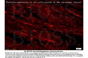 Formalin-fixed and paraffin embedded labeled with human gastric carcinoma Rabbit Anti-AIF Polyclonal Antibody, Unconjugated (ABIN724010) 1:300 followed by conjugation to the secondary antibody Goat Anti-Rabbit IgG, PE (AIF antibody  (AA 131-230))