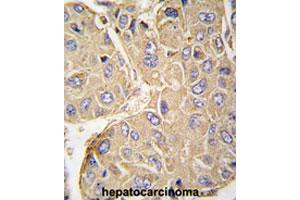 Formalin-fixed and paraffin-embedded human hepatocarcinomareacted with PTPN7 polyclonal antibody , which was peroxidase-conjugated to the secondary antibody, followed by AEC staining.