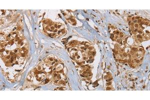 Immunohistochemistry of paraffin-embedded Human breast cancer tissue using RAB24 Polyclonal Antibody at dilution 1:45 (RAB24 antibody)