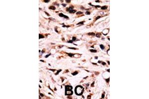 Formalin-fixed and paraffin-embedded human breast cancer tissue reacted with SMAD4 (phospho T277) polyclonal antibody  which was peroxidase-conjugated to the secondary antibody followed by DAB staining.