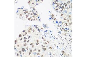 Immunohistochemistry of paraffin-embedded human prostate cancer using DDX39B antibody at dilution of 1:100 (40x lens). (DDX39B antibody)