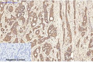 Immunohistochemical analysis of paraffin-embedded human liver cancer tissue. (Aquaporin 4 antibody)