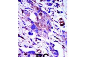 Formalin-fixed and paraffin-embedded human cancer tissue reacted with the primary antibody, which was peroxidase-conjugated to the secondary antibody, followed by AEC staining. (PLK1 antibody  (C-Term))