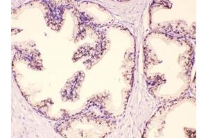 IHC testing of FFPE human prostate cancer tissue with GAA antibody at 1ug/ml. (GAA antibody  (AA 494-527))