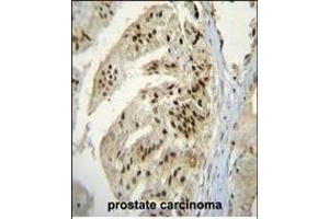 P Antibody (Center) (ABIN655637 and ABIN2845116) immunohistochemistry analysis in formalin fixed and raffin embedded human prostate carcinoma followed by peroxidase conjugation of the secondary antibody and DAB staining. (ACPP antibody  (AA 407-435))
