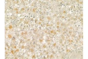 ABIN6258516 and ABIN6274735 at 1/100 staining human astrocytoma by IHC-P. (MRPL21 antibody  (Internal Region))