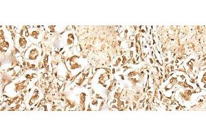 Immunohistochemistry of paraffin-embedded Human gastric cancer tissue using ZUFSP Polyclonal Antibody at dilution of 1:35(x200) (ZUFSP antibody)