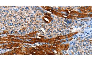 Immunohistochemistry of paraffin-embedded Human liver cancer using AOX1 Polyclonal Antibody at dilution of 1:65 (AOX1 antibody)