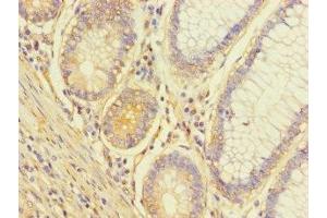 Immunohistochemistry of paraffin-embedded human colon cancer using ABIN7174650 at dilution of 1:100 (ALG14 antibody  (AA 25-216))