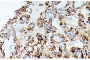 Immunohistochemistry of paraffin-embedded Human thyroid cancer using NUBP1 Polyclonal Antibody at dilution of 1:100 (40x lens). (NUBP1 antibody)