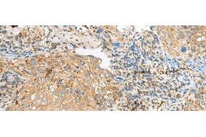 Immunohistochemistry of paraffin-embedded Human cervical cancer tissue using COPE Polyclonal Antibody at dilution of 1:50(x200) (COPE antibody)