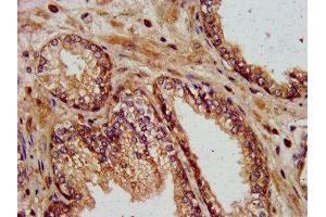 IHC image of ABIN7157591 diluted at 1:400 and staining in paraffin-embedded human prostate cancer performed on a Leica BondTM system. (KIF13B antibody  (AA 1531-1701))