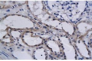 Formalin-fixed and paraffin embedded human kidney cancer labeled with Anti-HIF-2? (EPAS1 antibody  (AA 1-130))