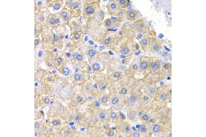 Immunohistochemistry of paraffin-embedded human liver cancer using CRK antibody at dilution of 1:200 (400x lens). (Crk antibody)