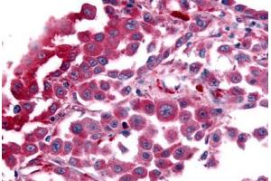 Anti-AVPR1B antibody IHC staining of human malignant melanoma. (AVPR1B antibody  (C-Term))