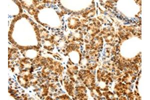 The image on the left is immunohistochemistry of paraffin-embedded Human thyroid cancer tissue using ABIN7128859(CDH23 Antibody) at dilution 1/80, on the right is treated with fusion protein. (CDH23 antibody)