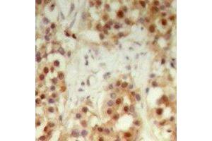 Immunohistochemical analysis of NXF3 staining in human breast cancer formalin fixed paraffin embedded tissue section. (NXF3 antibody)