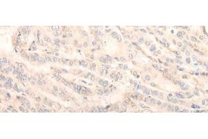 Immunohistochemistry of paraffin-embedded Human thyroid cancer tissue using INPP1 Polyclonal Antibody at dilution of 1:35(x200) (INPP1 antibody)