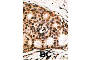 Formalin-fixed and paraffin-embedded human cancer tissue reacted with CDX1 polyclonal antibody  , which was peroxidase-conjugated to the secondary antibody, followed by AEC staining. (CDX1 antibody  (C-Term))