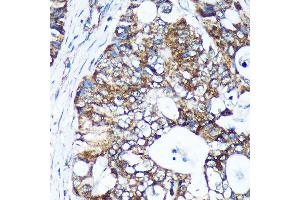 Immunohistochemistry of paraffin-embedded Human colon carcinoma using GULP1 Rabbit pAb (ABIN6131564, ABIN6141541, ABIN6141542 and ABIN6220256) at dilution of 1:100 (40x lens). (GULP1 antibody  (AA 1-130))