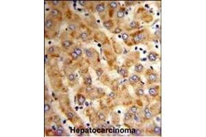 Formalin-fixed and paraffin-embedded human hepatocarcinoma reacted with HYOU1 Antibody (Center), which was peroxidase-conjugated to the secondary antibody, followed by DAB staining. (HYOU1 antibody  (AA 274-303))