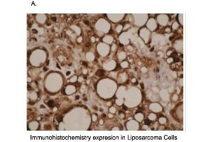 Immunohistochemical staining of human liposarcoma cells using CYP4F11 antibody .