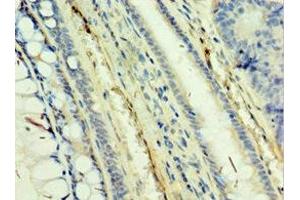 Immunohistochemistry of paraffin-embedded human colon cancer using ABIN7171470 at dilution of 1:100 (TAF5L antibody  (AA 1-325))