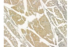 ABIN6264963 and ABIN6273315 at 1/100 staining human tongue carcinoma by IHC-P.