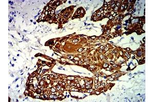 Immunohistochemical analysis of paraffin-embedded esophageal cancer tissues using KRT13 mouse mAb with DAB staining. (Cytokeratin 13 antibody  (AA 104-458))