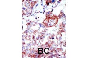 Formalin-fixed and paraffin-embedded human cancer tissue reacted with Ilk polyclonal antibody  , which was peroxidase-conjugated to the secondary antibody, followed by AEC staining. (ILK antibody  (N-Term))