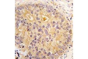 IHC analysis of FFPE human prostate carcinoma tissue stained with CAMKK2 antibody (CAMKK2 antibody  (AA 52-82))