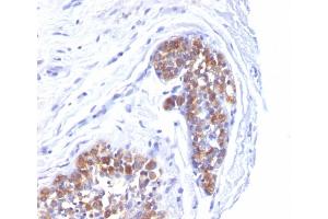 Formalin-fixed, paraffin-embedded human Breast Carcinoma stained with MUC-1 / EMA Mouse Monoclonal Antibody (MUC1/520). (MUC1 antibody)