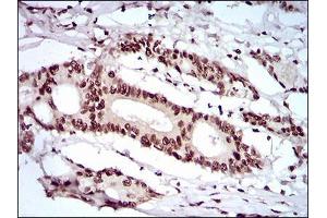 Immunohistochemical analysis of paraffin-embedded colon cancer tissues using KHDRBS2 mouse mAb with DAB staining. (KHDRBS2 antibody  (AA 160-349))