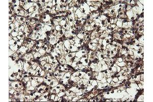 Immunohistochemical staining of paraffin-embedded Carcinoma of Human kidney tissue using anti-DOK7 mouse monoclonal antibody. (DOK7 antibody)