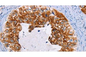 Immunohistochemistry of paraffin-embedded Human cervical cancer using CK-13 Polyclonal Antibody at dilution of 1:35 (Cytokeratin 13 antibody)
