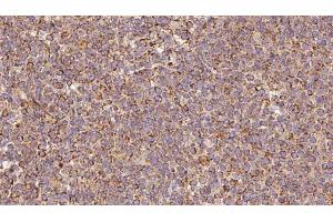 ABIN6273188 at 1/100 staining Human lymph cancer tissue by IHC-P.