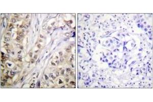 Immunohistochemistry analysis of paraffin-embedded human breast carcinoma tissue, using Survivin (Ab-117) Antibody. (Survivin antibody  (AA 86-135))