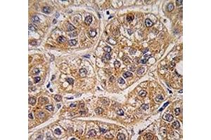 IHC analysis of FFPE human hepatocarcinoma tissue stained with AKR1A1 antibody (AKR1A1 antibody  (AA 293-325))