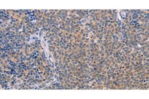 Immunohistochemistry of paraffin-embedded Human Lymphoma using CCL16 Polyclonal Antibody at dilution of 1:50 (CCL16 antibody)