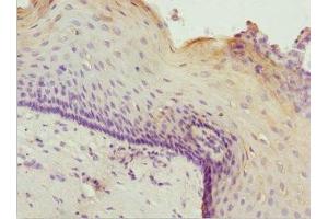 Immunohistochemistry of paraffin-embedded human cervical cancer using ABIN7176007 at dilution of 1:100 (ZNF187 antibody  (AA 239-478))