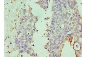 Immunohistochemistry of paraffin-embedded human endometrial cancer using ABIN7149988 at dilution of 1:100 (DPP8 antibody  (AA 10-230))