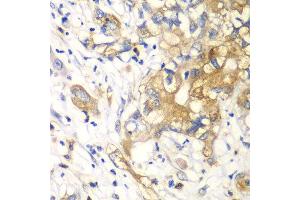 Immunohistochemistry of paraffin-embedded human liver cancer using KLK10 antibody at dilution of 1:100 (40x lens).