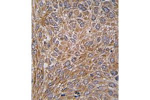 Formalin-fixed and paraffin-embedded human lung carcinoma tissue reacted with GIT1 Antibody  (ABIN391615 and ABIN2841536) , which was peroxidase-conjugated to the secondary antibody, followed by DAB staining.