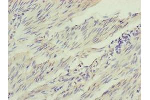 Immunohistochemistry of paraffin-embedded human bladder cancer using ABIN7156905 at dilution of 1:100 (IL1F9 antibody  (AA 1-169))