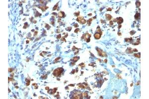 Formalin-fixed, paraffin-embedded human Gastric Carcinoma stained with MUC3 Monoclonal Antibody (MUC3/1154). (MUC3A antibody)