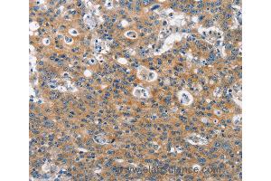 Immunohistochemistry of Human gastric cancer using CLTC Polyclonal Antibody at dilution of 1:60 (Clathrin Heavy Chain (CLTC) antibody)