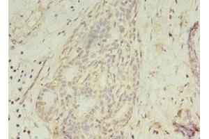 Immunohistochemistry of paraffin-embedded human breast cancer using ABIN7154452 at dilution of 1:100 (GCC1 antibody  (AA 4-775))
