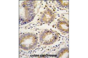 Formalin-fixed and paraffin-embedded human colon carcinoma tissue reacted with LEFTB antibody , which was peroxidase-conjugated to the secondary antibody, followed by DAB staining. (LEFTY1 antibody  (C-Term))