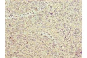Immunohistochemistry of paraffin-embedded human cervical cancer using ABIN7153904 at dilution of 1:100 (PGM2L1 antibody  (AA 101-400))